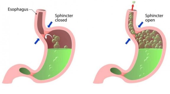 Is Belching Just Bad Manners? – The Functional Gut Clinic