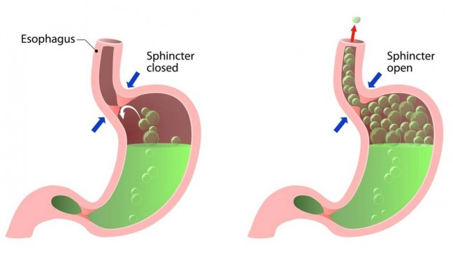 Is Belching Just Bad Manners The Functional Gut Clinic